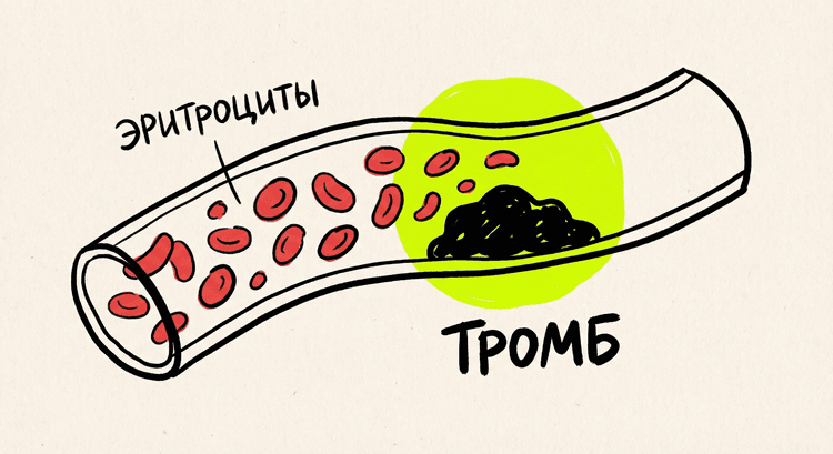 Образование тромба в кровеносном сосуде