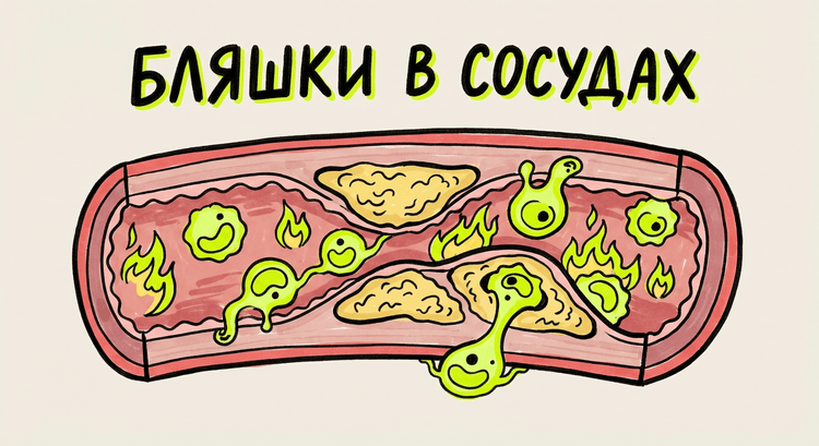 Бляшки в сосудах